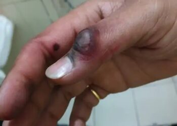 जेब में रखा मोबाइल ब्लास्ट : छात्र झुलसा, दोस्तों ने बुझाई आग